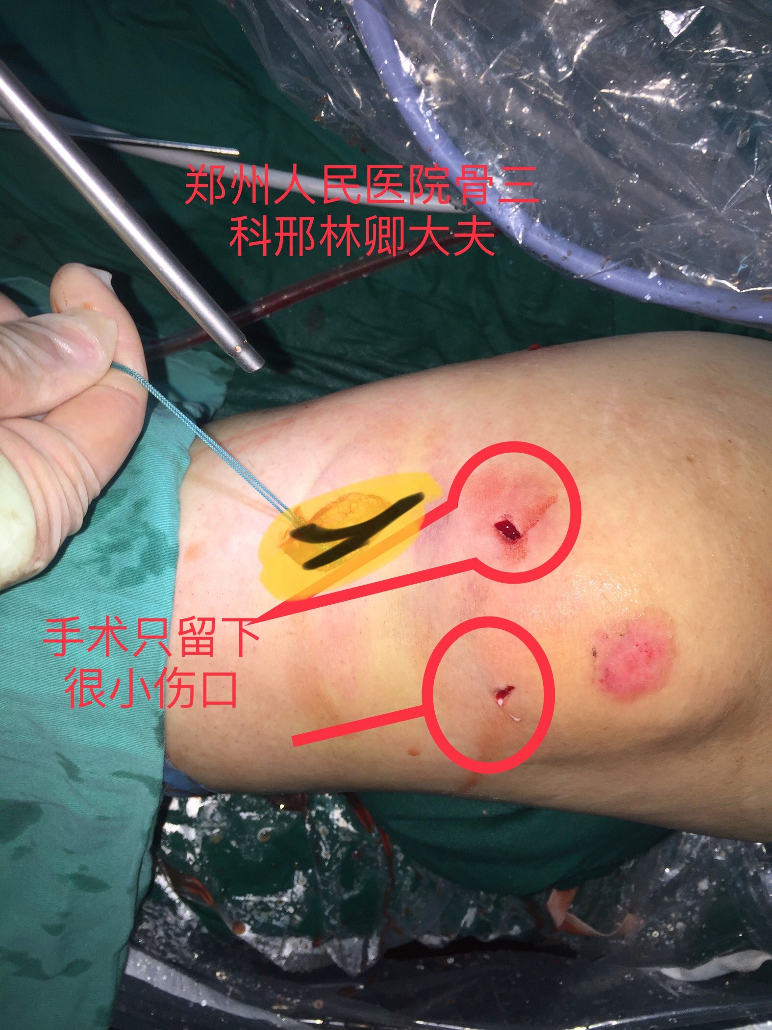 肛瘘手术要痛多久_肛瘘手术 多长时间不疼_疼多长手术肛瘘时间久