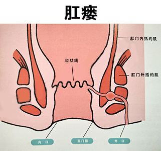 肛瘘手术 多长时间不疼_疼多长手术肛瘘时间久_肛瘘手术要痛多久