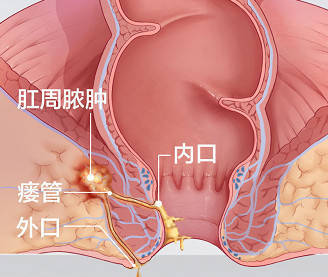 肛瘘手术要痛多久_肛瘘手术 多长时间不疼_疼多长手术肛瘘时间久